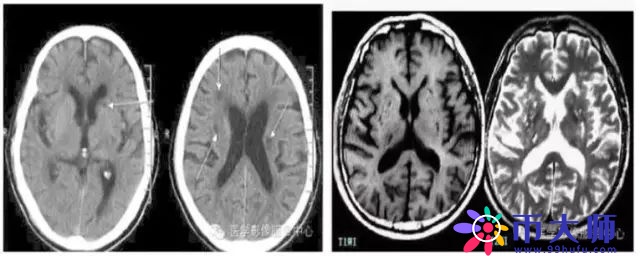 腔隙性脑梗死诊疗中的9大雷区，你踩过吗？