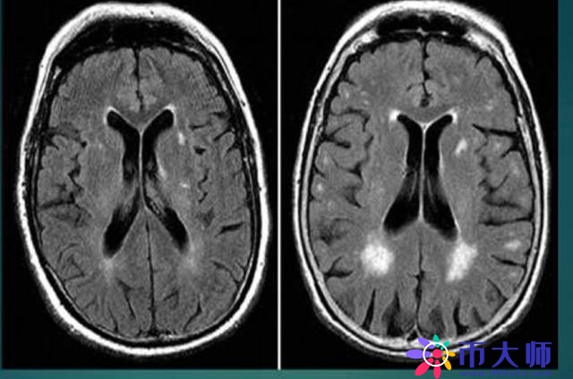 腔隙性脑梗死诊疗中的9大雷区，你踩过吗？