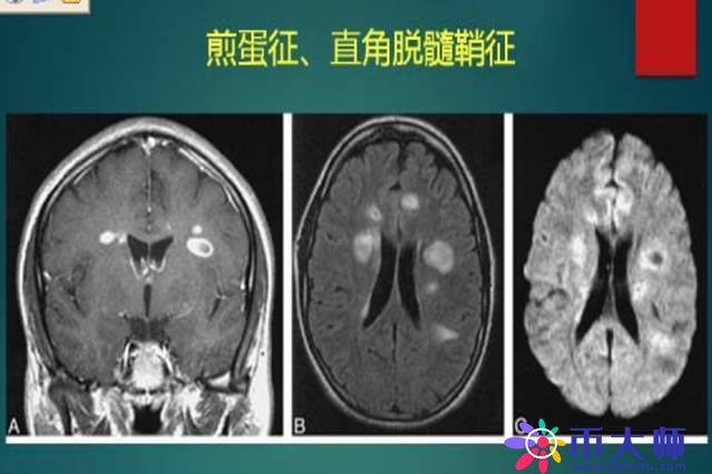 腔隙性脑梗死诊疗中的9大雷区，你踩过吗？